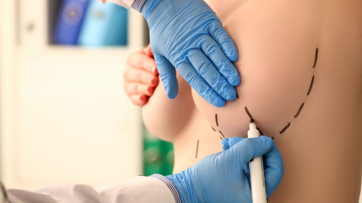 Mamoplastia
